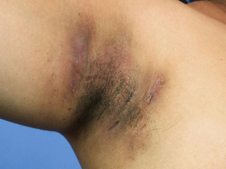 10 Celebrities with Hidradenitis Suppurativa