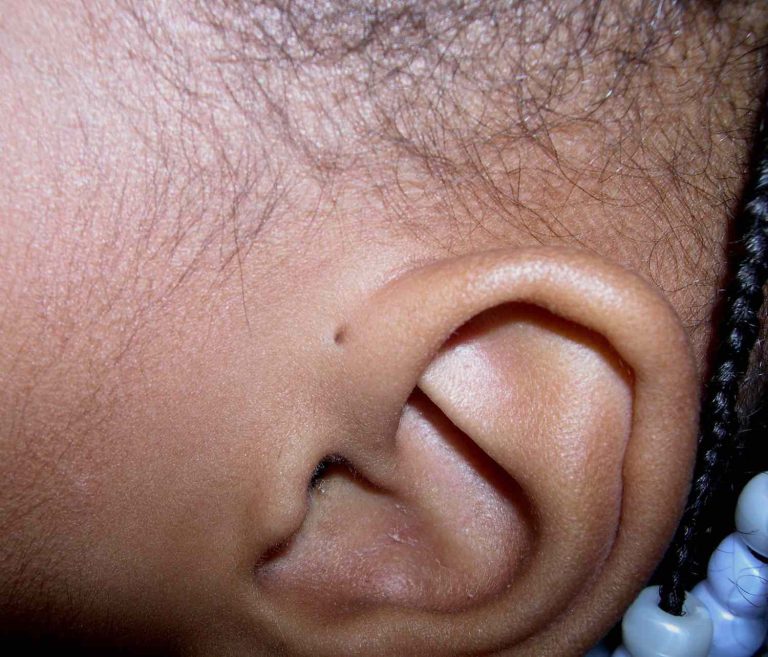 These 5 Celebrities Also Have a Preauricular Sinus (Aka Preauricular Pit) In their Ears